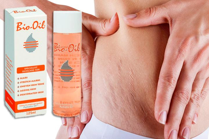 Er du plaget af strækmærker, acne ar, aldrende og tør hud? Nu kan du forbedre udseendet af disse markant med den specialiserede hudplejeolie Bio-Oil!1 