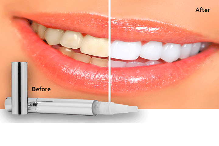 Tandblegnings pen, der giver dig smukke, hvide tænder 1 